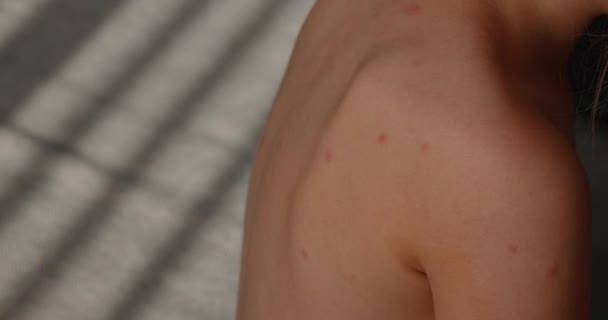 Skin Child Rashes Five Year Old Girl Chickenpox Measles Monkeypox — стоковое видео