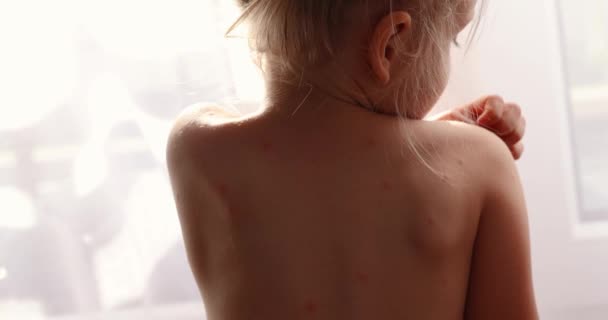 Girl Itches Skin Rashes Five Year Old Girl Chickenpox Measles — Vídeo de Stock