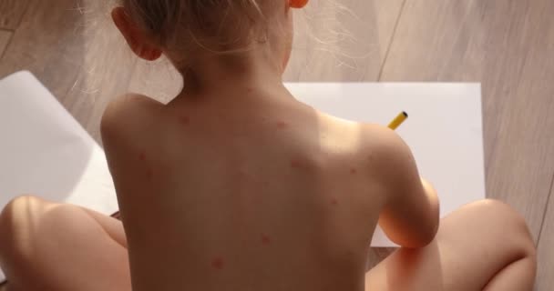 Five Year Old Girl Chickenpox Measles Monkeypox Virus Sick Child — Stock video