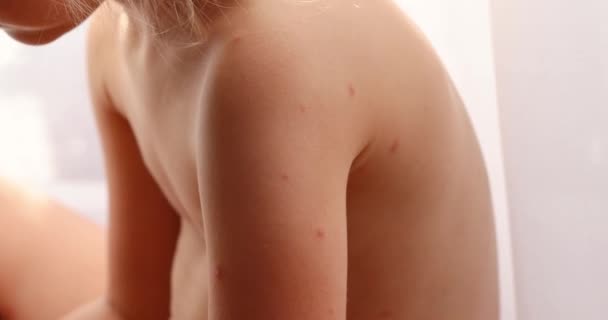 Five Year Old Girl Chickenpox Measles Monkeypox Virus — Video