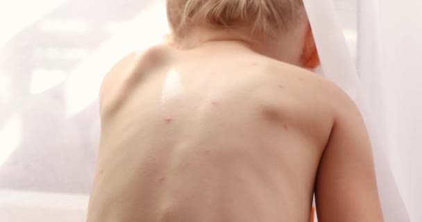 Skin Child Rashes Five Year Old Girl Chickenpox Measles Monkeypox — Video Stock
