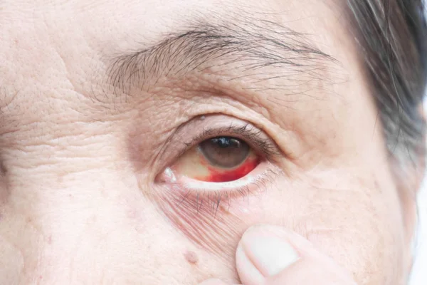 Крупный План Пожилая Женщина Лопнувшей Кровью Глазах Здравоохранение Медикаментозное Понятие — стоковое фото