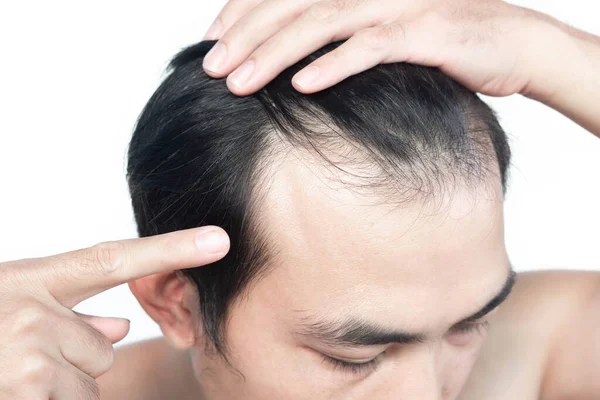 Nahaufnahme Junger Mann Ernstes Haarausfall Problem Mit Weißem Hintergrund Für — Stockfoto