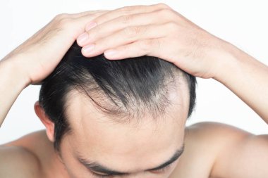 Sağlık hizmetleri tıbbi ve şampuan ürünleri konsepti için beyaz bir grupla ciddi saç kaybı sorunu yaşayan genç adam.