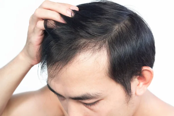 Detailní Záběr Mladý Muž Vážné Vypadávání Vlasů Problém Bílým Backgroun — Stock fotografie