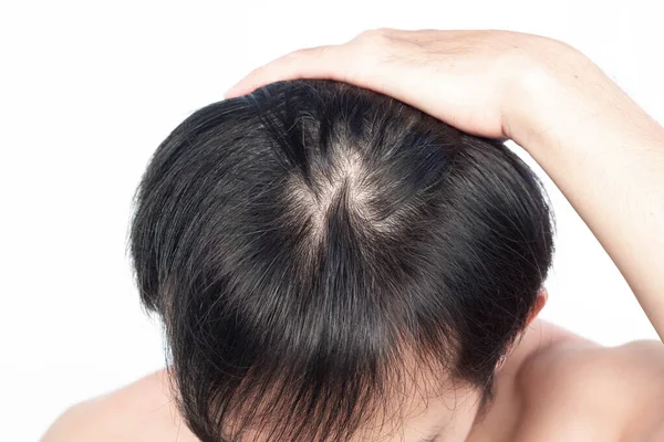 Zbliżenie Młody Człowiek Poważne Wypadanie Włosów Problem Siwych Włosów Białym — Zdjęcie stockowe