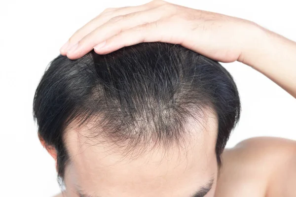 Nahaufnahme Junger Mann Ernstes Haarausfall Problem Mit Weißem Hintergrund Für — Stockfoto