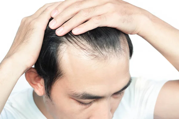 Closeup Young Man Serious Hair Loss Problem White Backgroun Health — Stock Photo, Image