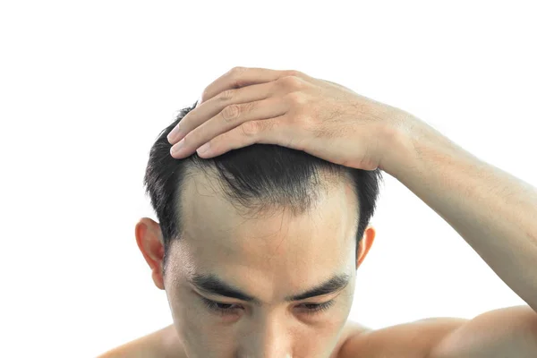 Closeup Young Man Serious Hair Loss Problem White Backgroun Health — Stock Photo, Image