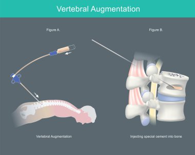 Vertebral Güçlendirme. Omurga dayanıklılığı için insan kemiğine özel bir çimento enjeksiyonu.