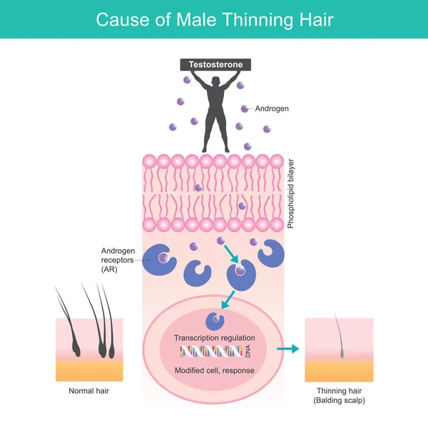男性の薄毛の原因 問題を説明するためのイラスト感度とアンドロゲン細胞受容体による男性の薄い髪の原因 — ストックベクタ