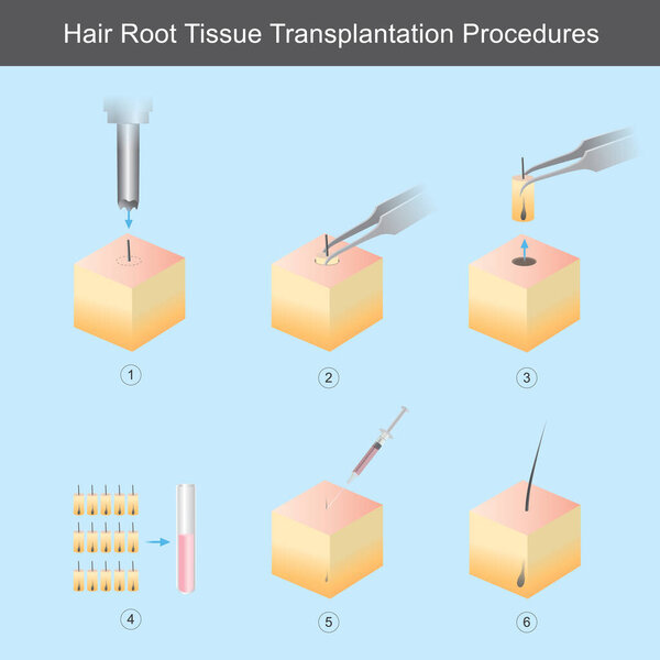 Hair Root Tissue Transplantation Procedures. Illustration showing technical steps of Hair Root Tissue Transplantation Procedure