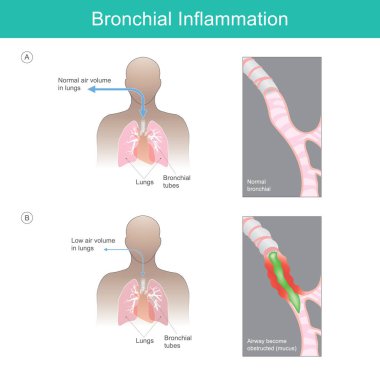 Bronşiyal iltihap. İllülasyon bir virüs, bakteri ya da tahriş edici parçacıklardan kaynaklanan bronşiyal iltihabı açıklar.