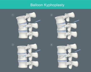 Balon Kyphoplasty. Sıkıştırma çatlaklarının düzeltilmesi ve omurga yüksekliğinin düzeltilmesi için tıbbi adımlar. Görüntü