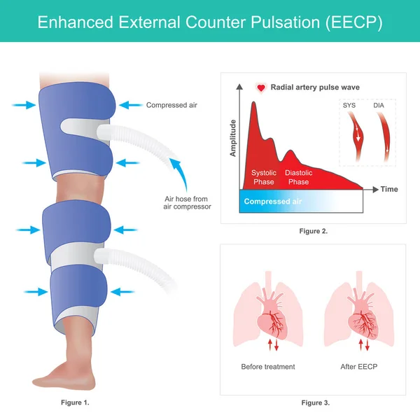 Pulsaciones Externas Mejoradas Método Para Mejorar Flujo Sanguíneo Corazón Mediante — Vector de stock