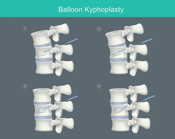 Balon Kyphoplasty. Sıkıştırma çatlaklarının düzeltilmesi ve omurga yüksekliğinin düzeltilmesi için tıbbi adımlar. Görüntü