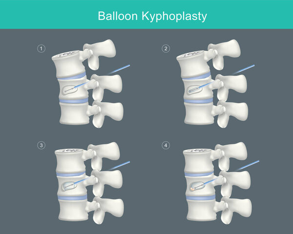 Шариковая кифопластика. Медицинские шаги для коррекции компрессионных переломов и восстановления высоты позвоночника. Иллюстрация