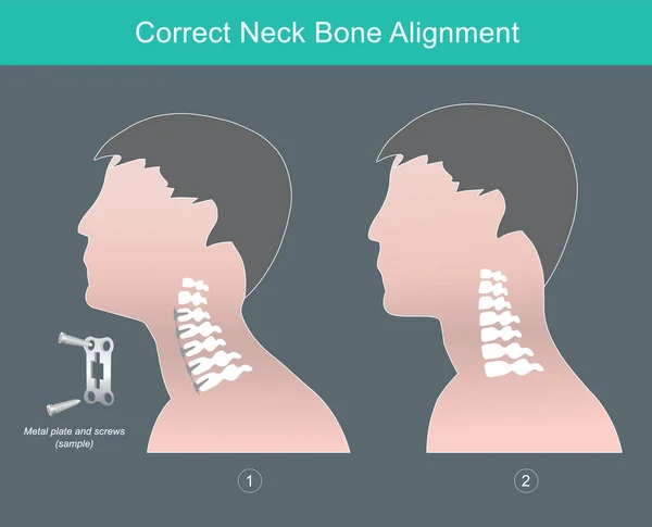 正确的颈骨对齐 向人类展示正确的颈骨对齐 — 图库矢量图片