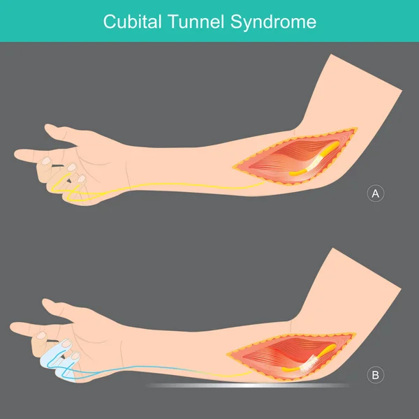 Sindrome Del Tunnel Cubitale Una Condizione Che Comporta Pressione Stiramento — Vettoriale Stock