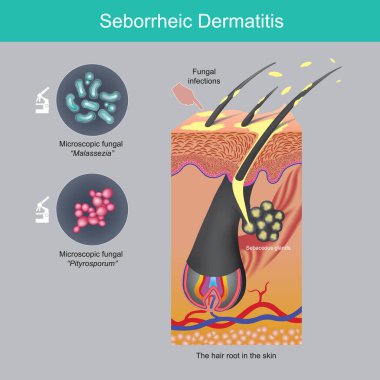 Seborrheic Dermatitis. Saç köklerindeki yağlı bezler ve kafa derisindeki mantarlardan kaynaklanan kafa derisi dökülmesi sorunu.