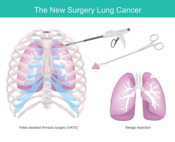 肺癌的外科技术 因癌症而切除部分肺的外科技术 — 图库矢量图片