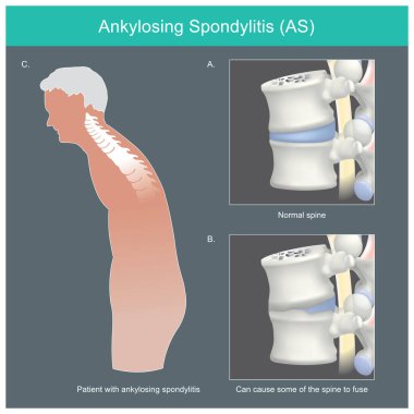 Ankylosing spondylitis. Human spine deformities from inflammation and can cause some of the spine to fuse clipart