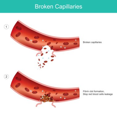 Broken capillaries. caused from blood capillaries expand too much clipart