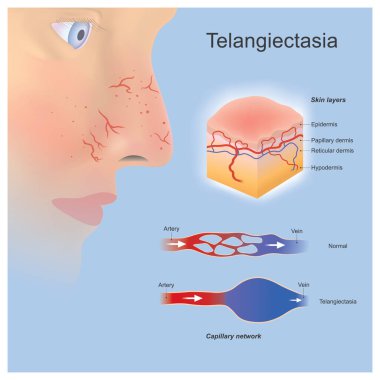 Telangiectasia. Problem tiny blood vessels widened or formed located near surface skin layers and you can clearly see clipart