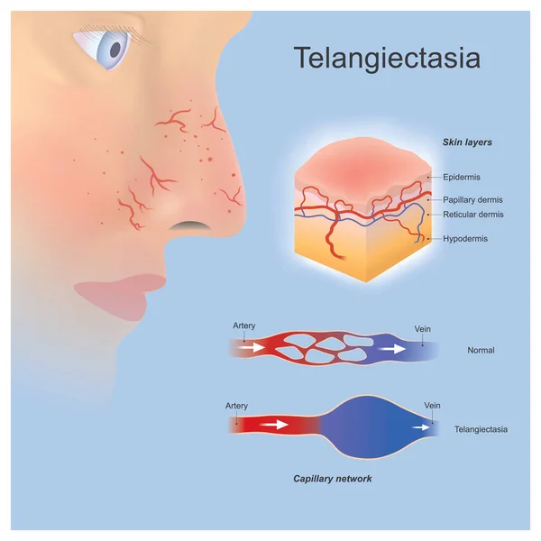 Telangiectasia Sorunlu Küçük Kan Damarları Genişlemiş Yüzey Katmanları Yakınında Oluşmuş — Stok Vektör