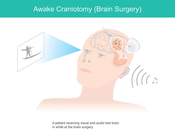 Despierta Craneotomía Paciente Que Recibe Pruebas Visuales Auditivas Del Cerebro — Vector de stock