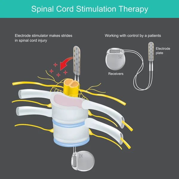 Spinal Cord Stimulation Therapy Electronic Tool Implant Body Use Neck — Stockový vektor