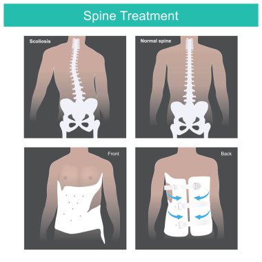 Spine Treatment. He has abnormal spine and after medical usage tool treatment. Illustration anatomy body