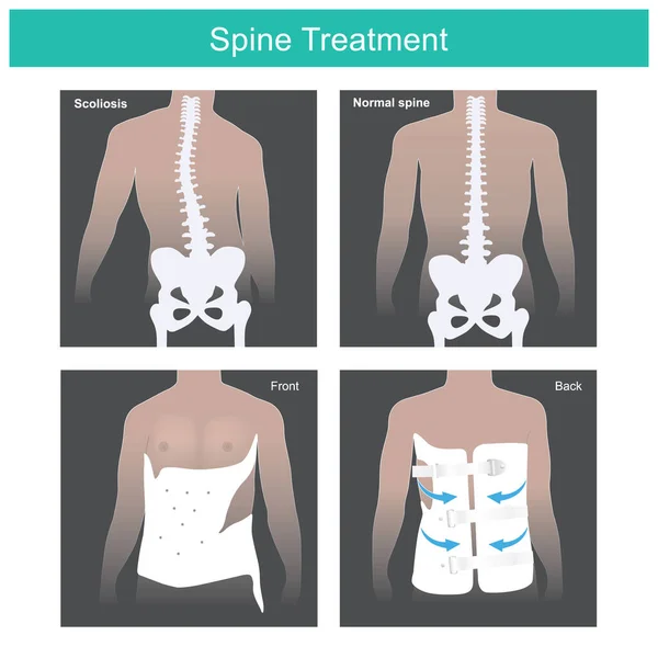 Лечение Позвоночника Аномальный Позвоночник После Лечения Инструментом Медицинского Применения Иллюстрационная — стоковый вектор