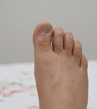 İhmal edilmiş erkek ayak parmakları, mantar hastalıkları, ayak parmaklarında nasırlar.