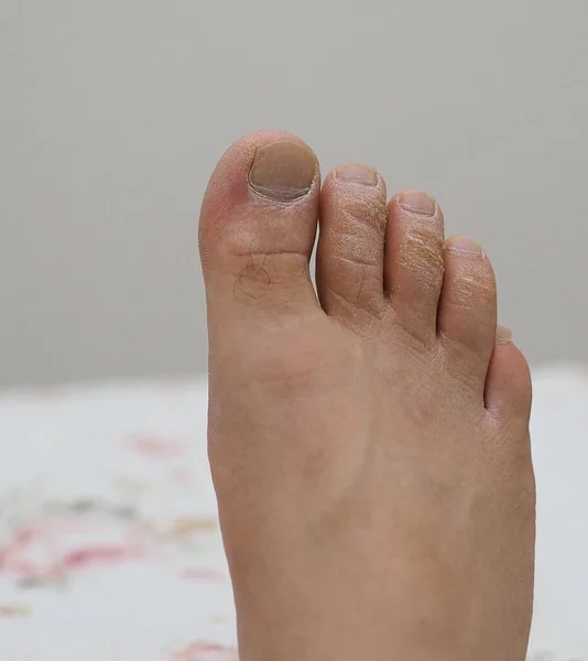 Opomíjené Mužské Prsty Nohou Plísňové Prsty Plísňové Onemocnění Mozoly Nohou — Stock fotografie
