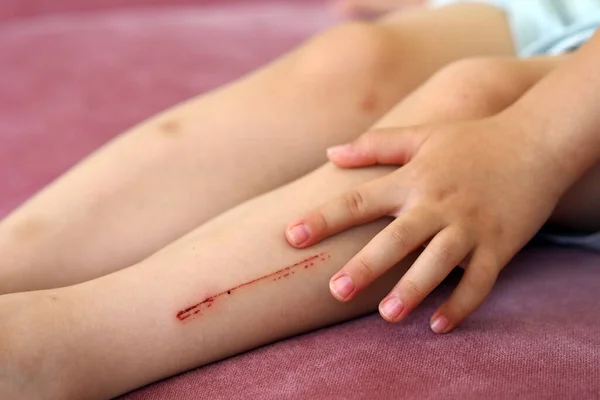 Das Verletzte Bein Eines Kindes Das Zerkratzte Und Verletzte Bein — Stockfoto