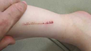 Bir çocuğun yaralı bacağı, bir çocuğun çizik ve yaralı bacağı.,