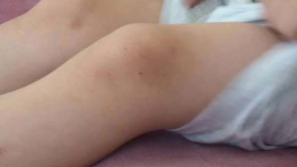 Egy Karcolás Ami Nyomot Hagy Lábon Gyermek Lába Megsérült — Stock videók