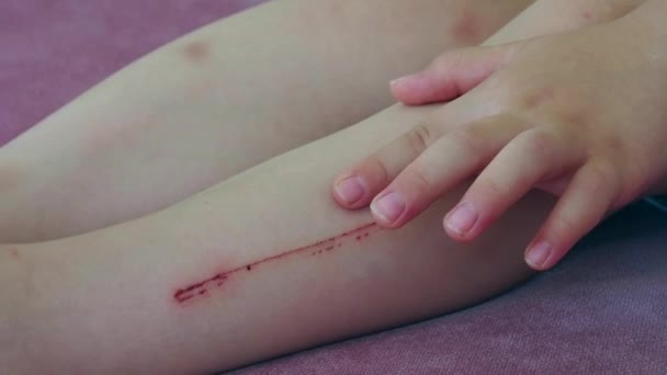 在腿上留下痕迹的划伤 孩子的腿受了伤 — 图库视频影像