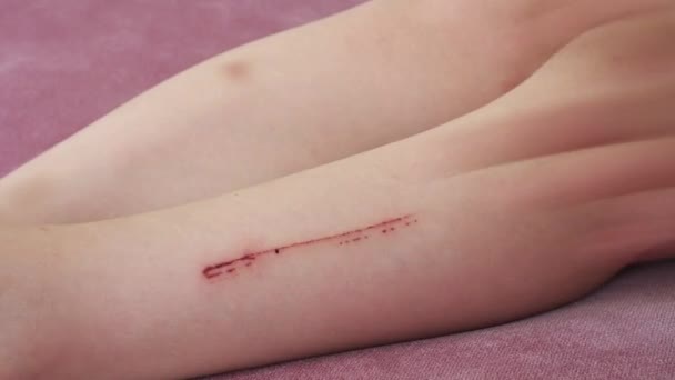Bir Çocuğun Yaralı Bacağı Bir Çocuğun Çizik Yaralı Bacağı — Stok video