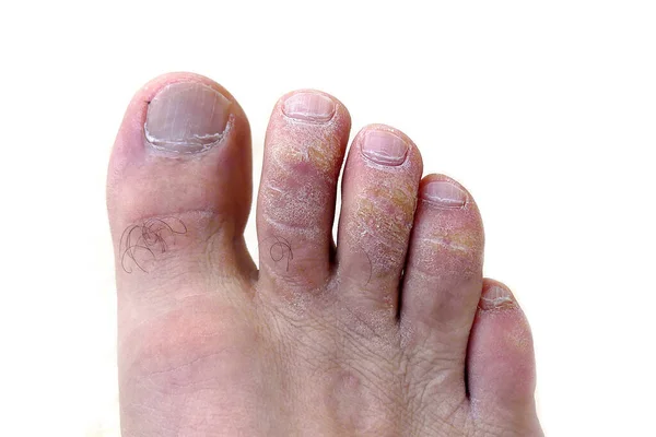 Close Uma Doença Fúngica Nos Dedos Dos Pés Uma Pessoa — Fotografia de Stock