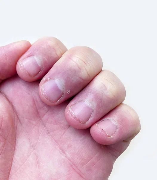 Hautpeeling Fingernägeln Vitamin Mangel Und Nagelhauterkrankungen — Stockfoto