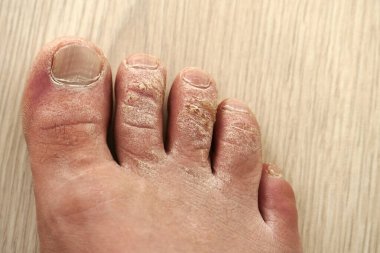 Bir adamın ayak parmaklarında yakın çekim nasır şekli, el parmaklarında ölü deri.,