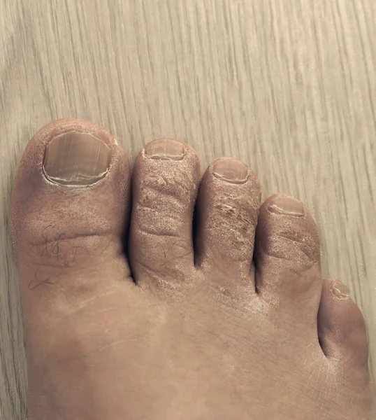 close-up callus formation on the toes of a man, dead skin on the fingers,