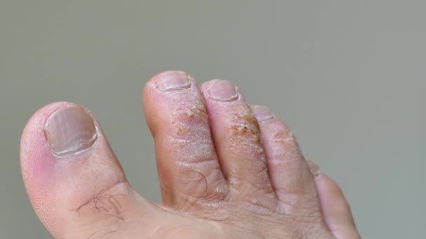 Nahaufnahme Schwielowbildung Den Zehen Eines Mannes Abgestorbene Haut Den Fingern — Stockvideo