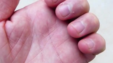 Tırnak derisi soyuluyor, C vitamini eksikliği ve tırnak derisi hastalıkları.,