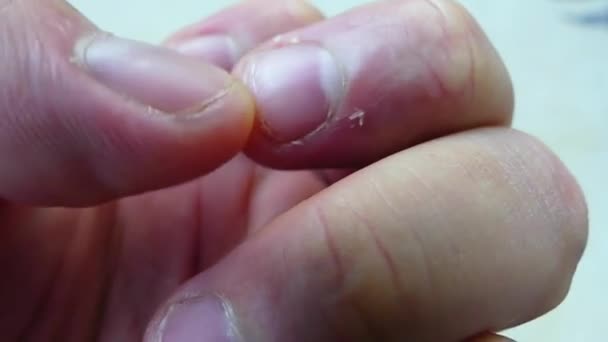 손가락 손톱에 벗겨진 비타민 — 비디오