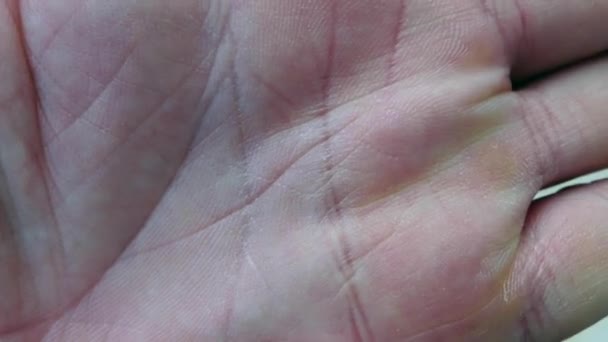 Skin Peeling Finger Nails Vitamin Deficiency Nail Skin Diseases — Stock Video