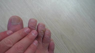 Parmaklarında nasır olan biri parmaklarını kaşır, kontrol eder, nasırlı parmakları vardır.,