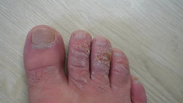 手足の皮膚病 指の発赤 つま先の上部の発赤 — ストック動画